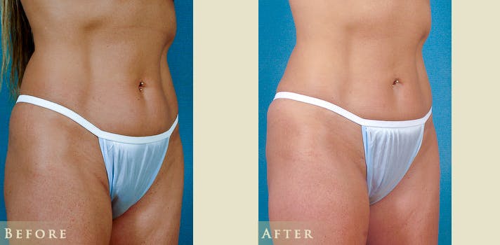 Female Liposuction Before & After Gallery - Patient 629448 - Image 2