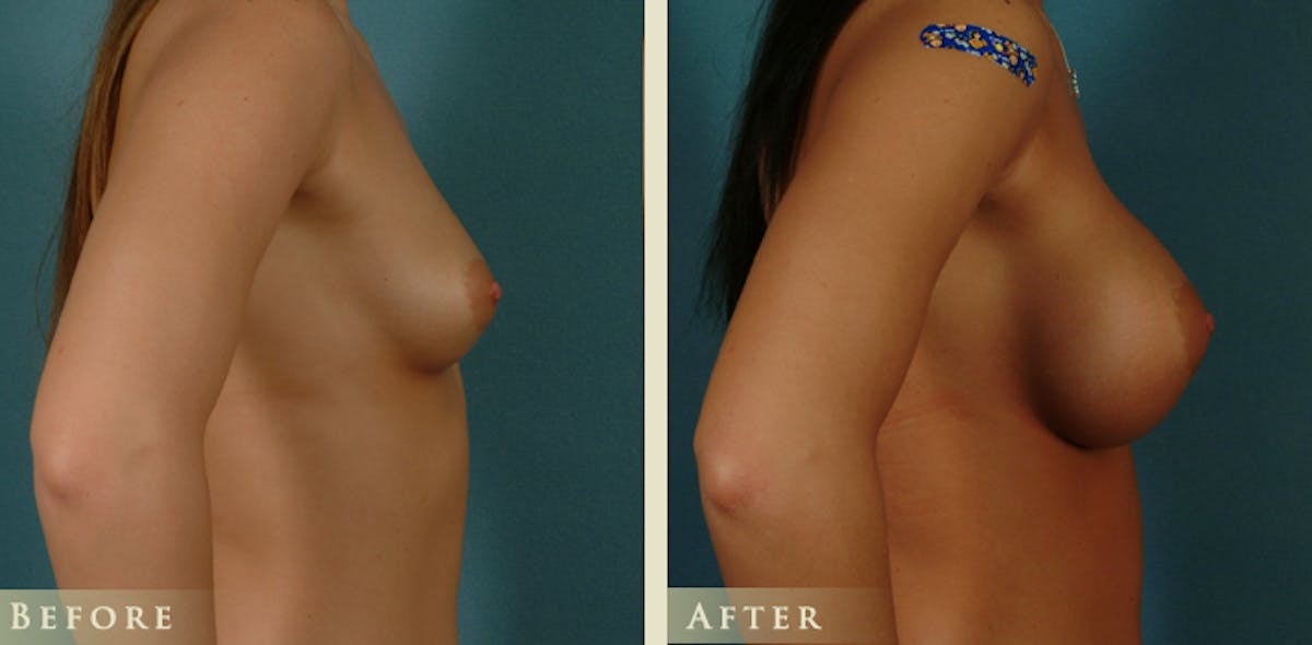 Breast Augmentation with Saline Implants Before & After Gallery - Patient 890465 - Image 3