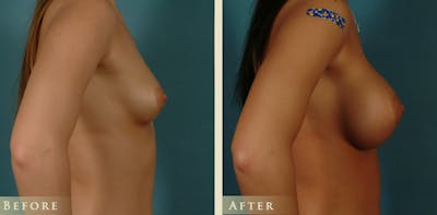 Breast Augmentation Before & After Gallery - Patient 515000 - Image 3