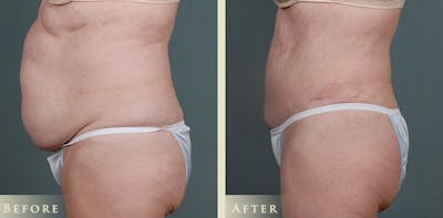 Tummy Tuck Before & After Gallery - Patient 363613 - Image 3