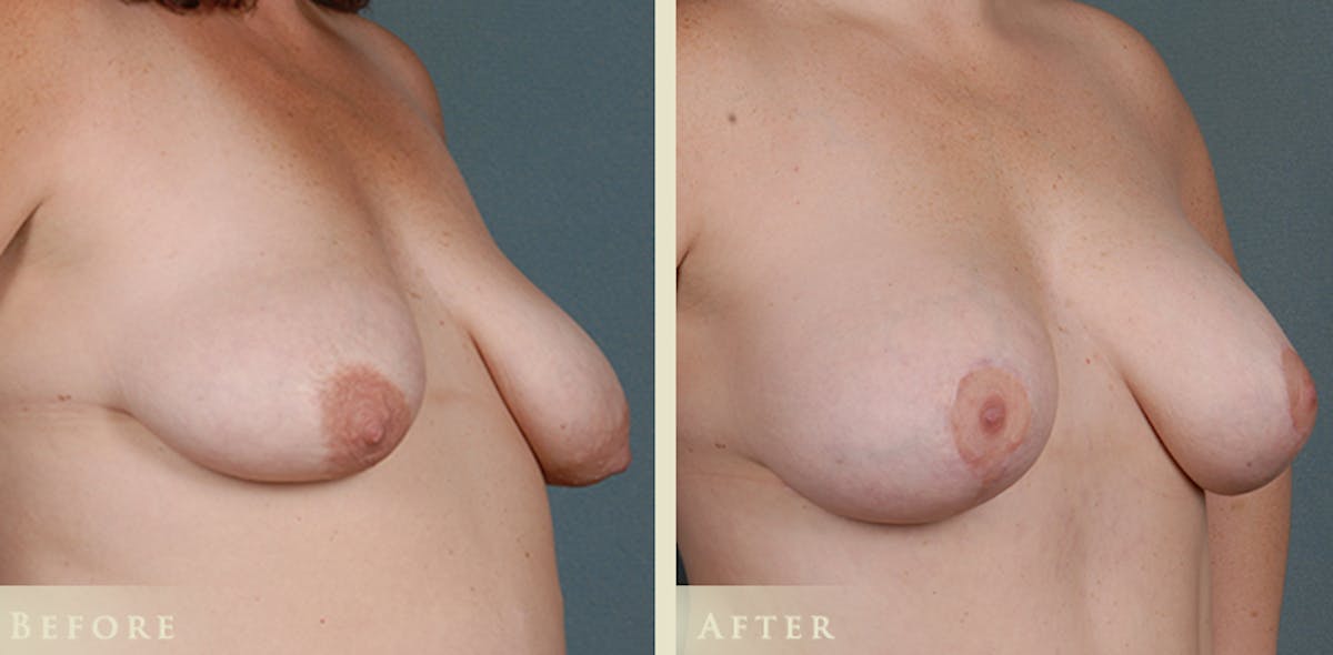 Breast Augmentation and Lift  Before & After Gallery - Patient 165909 - Image 2