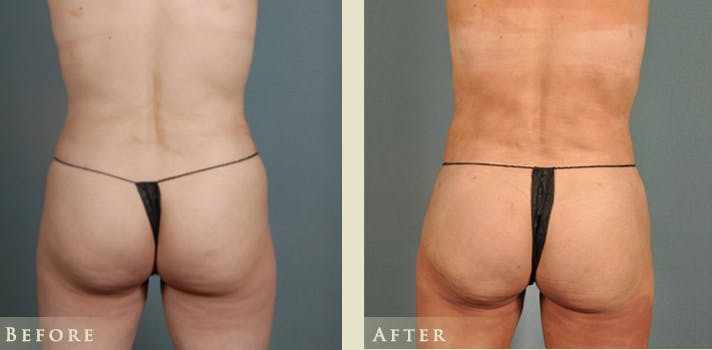 Brazilian Butt Lift Before & After Gallery - Patient 195034 - Image 1