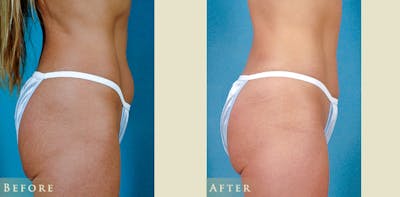 Female Liposuction Before & After Gallery - Patient 629448 - Image 3
