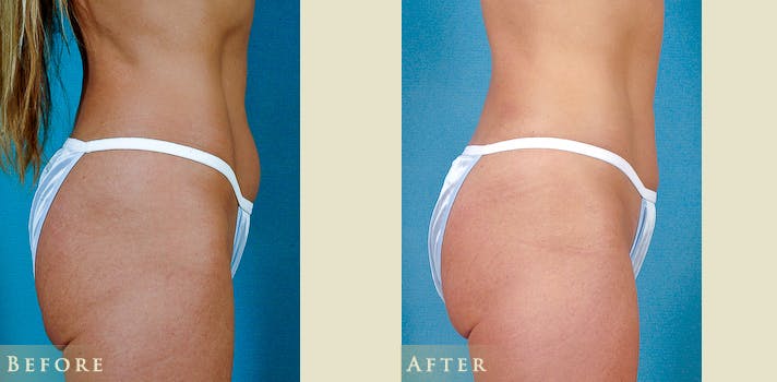Female Liposuction Before & After Gallery - Patient 629448 - Image 3