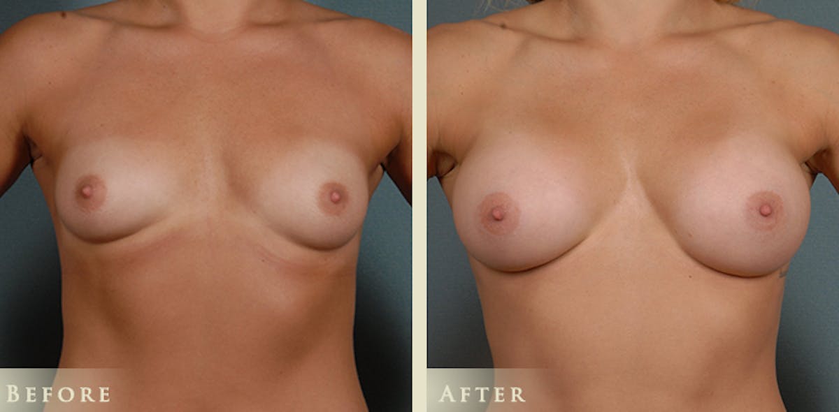 Breast Augmentation with Silicone Implants Before & After Gallery - Patient 422241 - Image 1