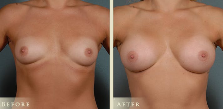 Breast Augmentation Before & After Gallery - Patient 422241 - Image 1