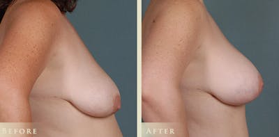 Breast Augmentation and Lift Before & After Gallery - Patient 165909 - Image 3