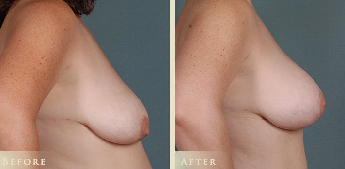 Breast Augmentation and Lift  Before & After Gallery - Patient 165909 - Image 3