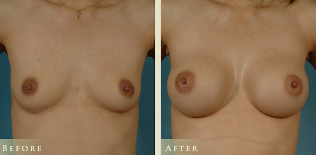 Breast Augmentation with Saline Implants Before & After Gallery - Patient 335623 - Image 1