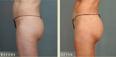 Brazilian Butt Lift Before & After Gallery - Patient 195034 - Image 2