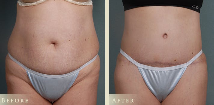 Tummy Tuck Before & After Gallery - Patient 302920 - Image 1
