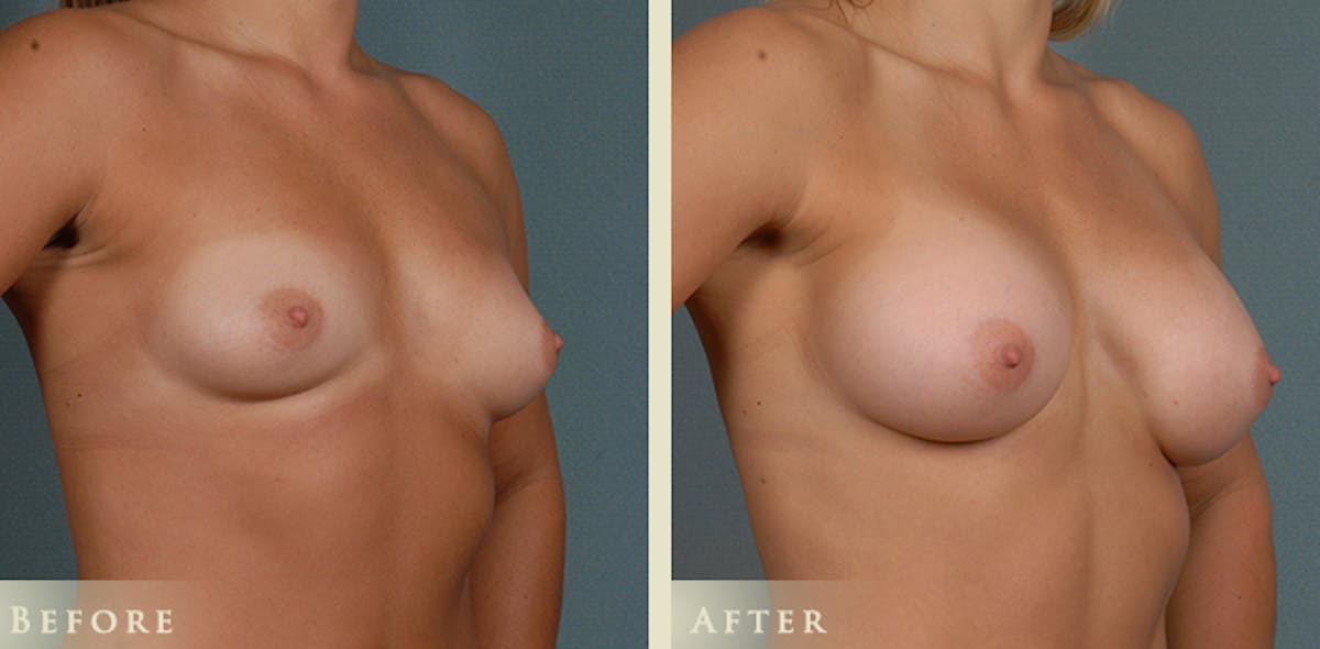 Breast Augmentation with Silicone Implants Before & After Gallery - Patient 422241 - Image 2