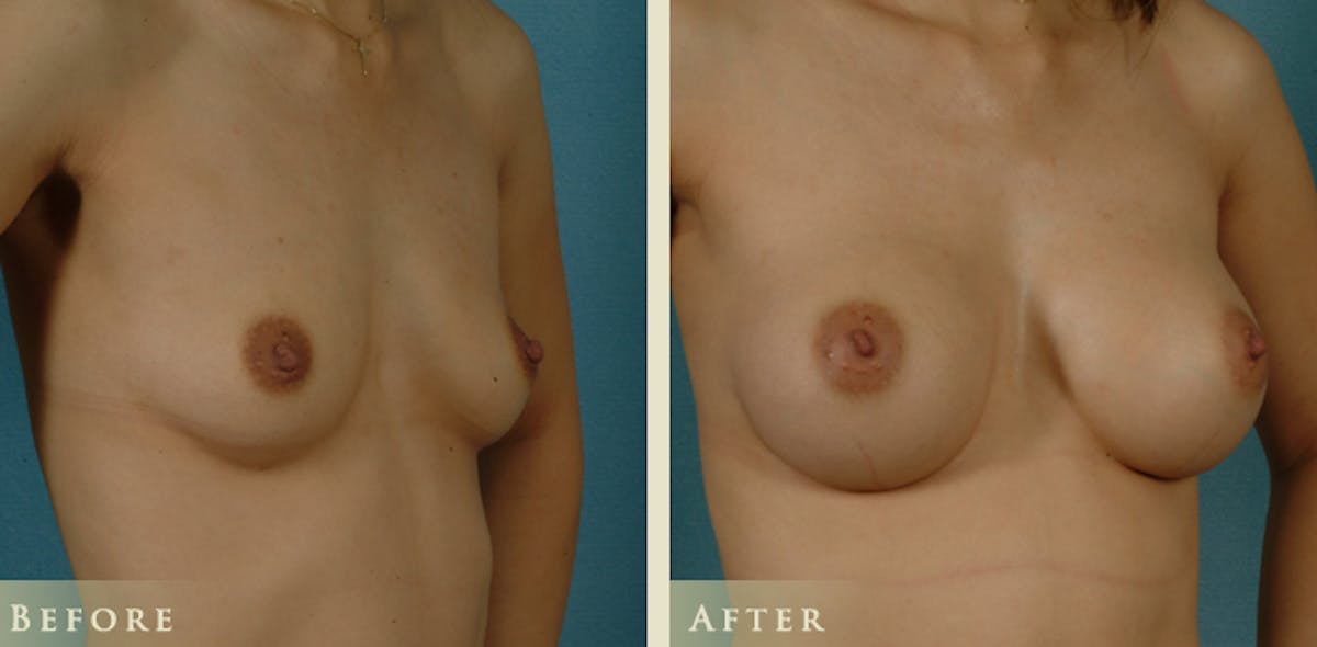 Breast Augmentation with Saline Implants Before & After Gallery - Patient 335623 - Image 2