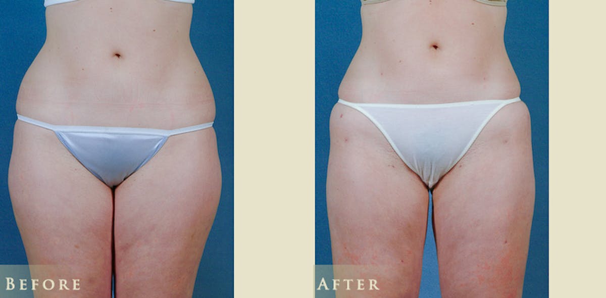 Female Liposuction Before & After Gallery - Patient 121025 - Image 1