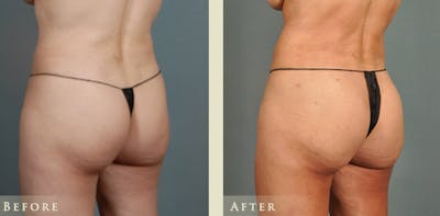 Brazilian Butt Lift Before & After Gallery - Patient 195034 - Image 3