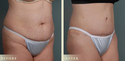 Tummy Tuck Before & After Gallery - Patient 302920 - Image 2