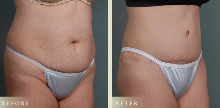 Tummy Tuck Before & After Gallery - Patient 302920 - Image 2