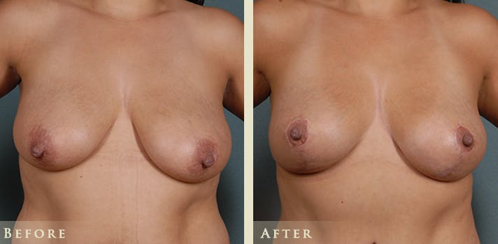 Breast Lift Before & After Gallery - Patient 523568 - Image 1