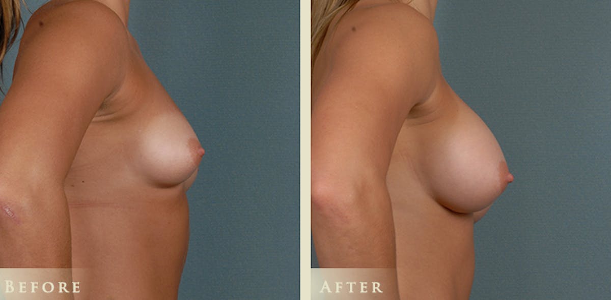 Breast Augmentation with Silicone Implants Before & After Gallery - Patient 422241 - Image 3