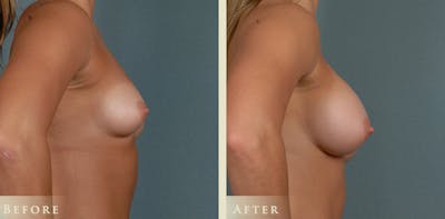 Breast Augmentation Before & After Gallery - Patient 422241 - Image 3