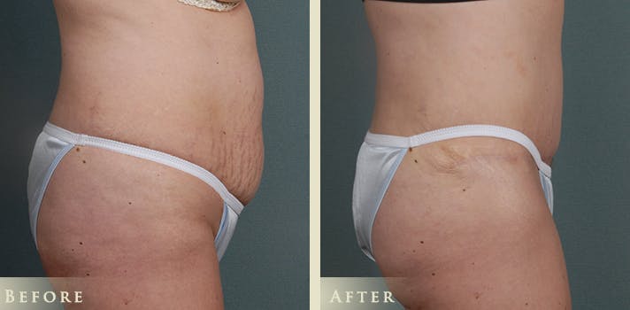 Tummy Tuck Before & After Gallery - Patient 302920 - Image 3