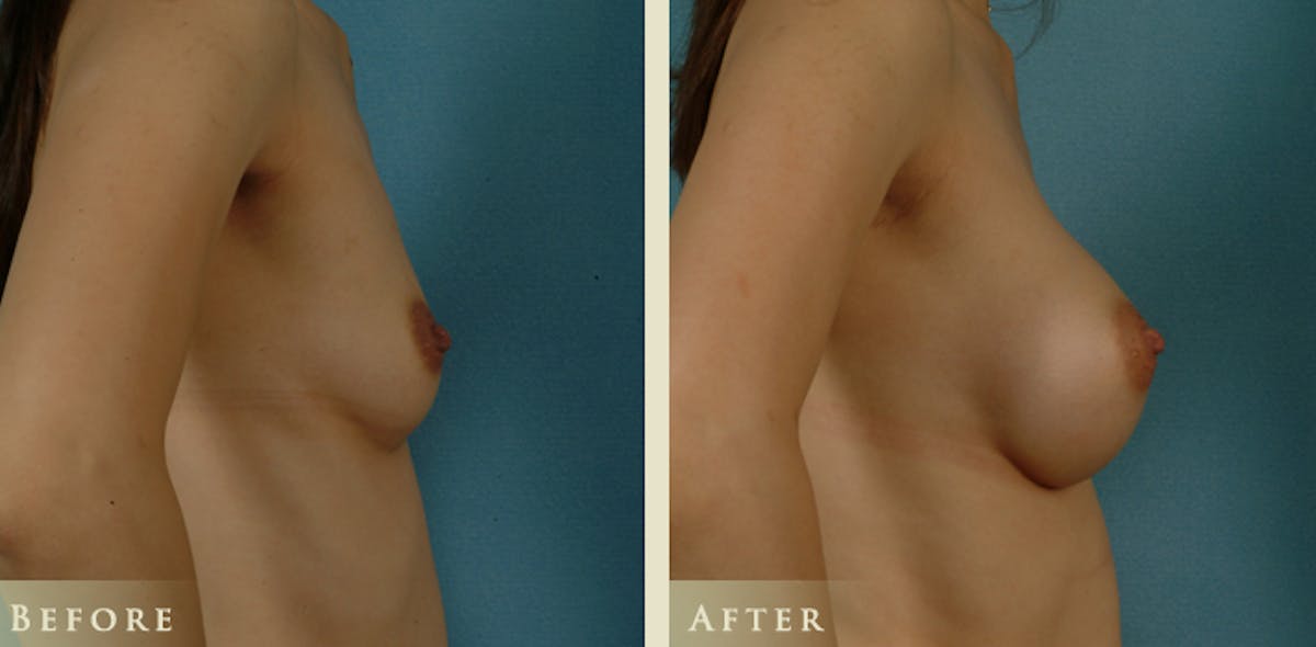 Breast Augmentation with Saline Implants Before & After Gallery - Patient 335623 - Image 3