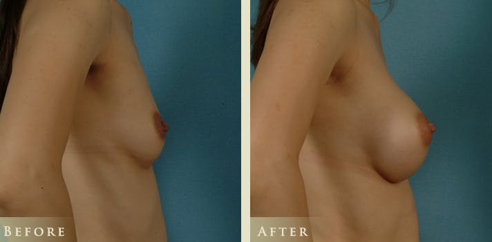 Breast Augmentation Before & After Gallery - Patient 139641 - Image 3