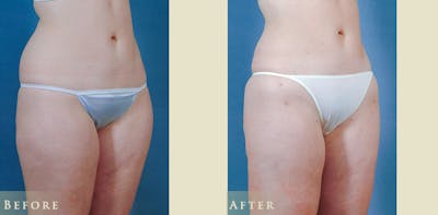 Female Liposuction Before & After Gallery - Patient 121025 - Image 2