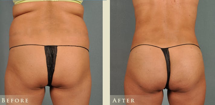 Brazilian Butt Lift Before & After Gallery - Patient 408196 - Image 1