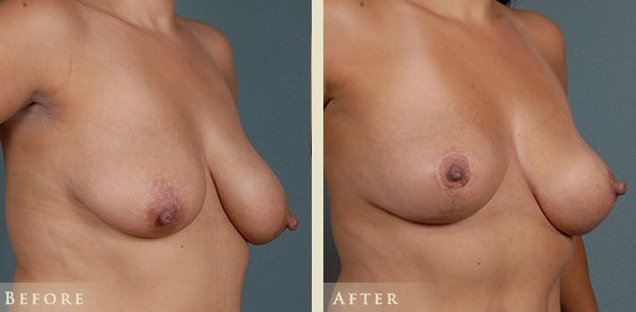 Breast Lift Before & After Gallery - Patient 523568 - Image 2