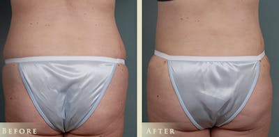 Tummy Tuck Before & After Gallery - Patient 302920 - Image 4