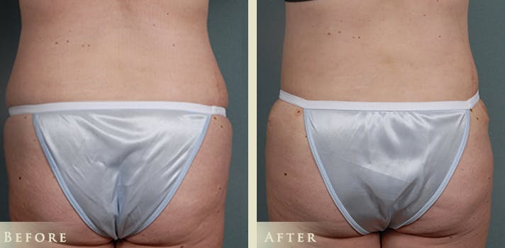 Tummy Tuck Before & After Gallery - Patient 302920 - Image 4