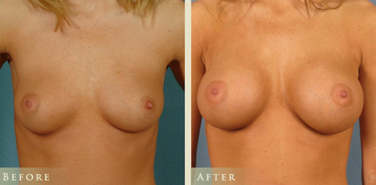 Breast Augmentation with Saline Implants Before & After Gallery - Patient 365606 - Image 1