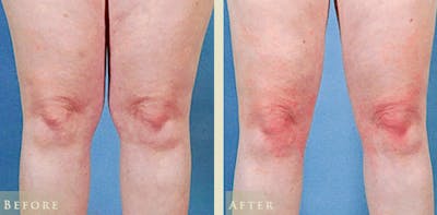 Female Liposuction Before & After Gallery - Patient 121025 - Image 3