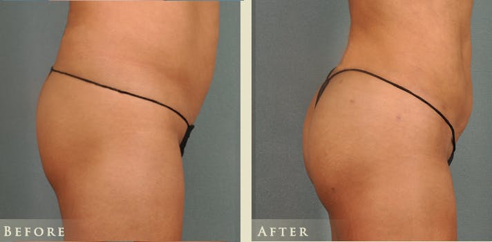 Brazilian Butt Lift Before & After Gallery - Patient 408196 - Image 2