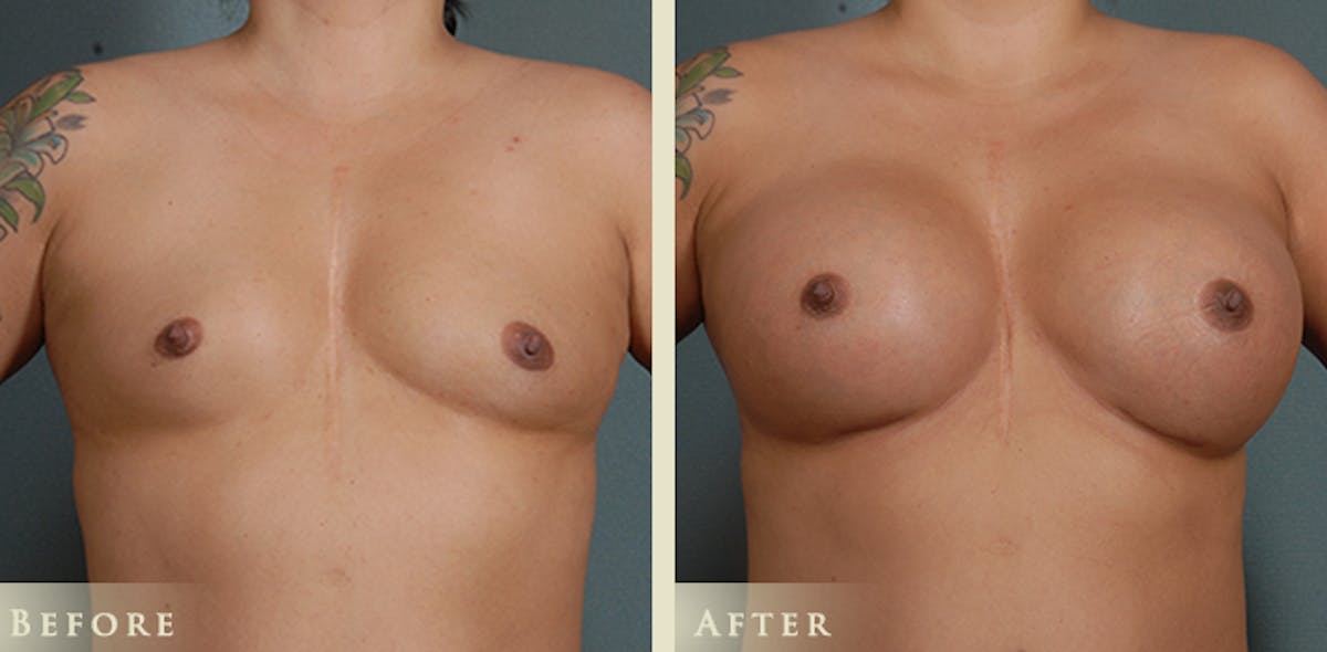 Breast Augmentation with Silicone Implants Before & After Gallery - Patient 244963 - Image 1