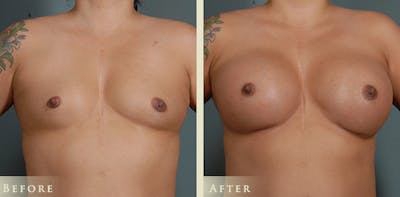 Breast Augmentation Before & After Gallery - Patient 244963 - Image 1