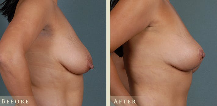 Breast Lift Before & After Gallery - Patient 523568 - Image 3