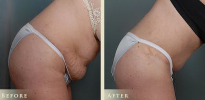 Tummy Tuck Before & After Gallery - Patient 302920 - Image 5