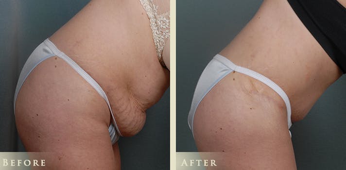 Tummy Tuck Before & After Gallery - Patient 302920 - Image 5