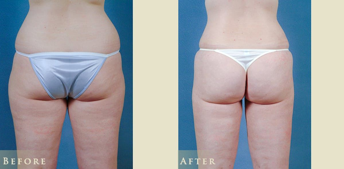 Female Liposuction Before & After Gallery - Patient 121025 - Image 4