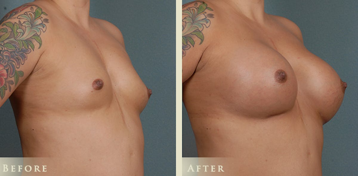 Breast Augmentation with Silicone Implants Before & After Gallery - Patient 244963 - Image 2
