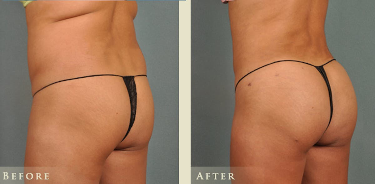 Brazilian Butt Lift Before & After Gallery - Patient 408196 - Image 3
