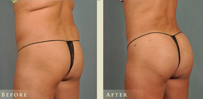 Brazilian Butt Lift Before & After Gallery - Patient 408196 - Image 3