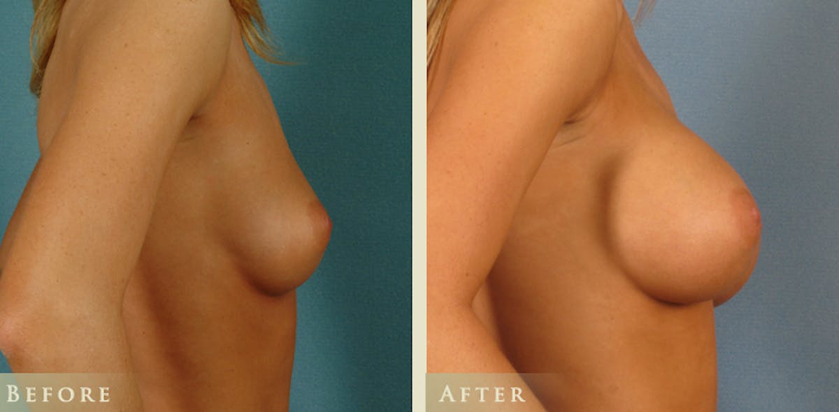 Breast Augmentation with Saline Implants Before & After Gallery - Patient 365606 - Image 2