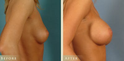 Breast Augmentation Before & After Gallery - Patient 202909 - Image 2