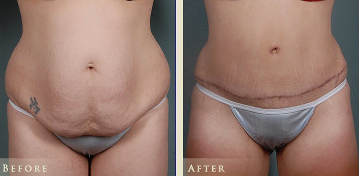 Tummy Tuck Before & After Gallery - Patient 185889 - Image 1
