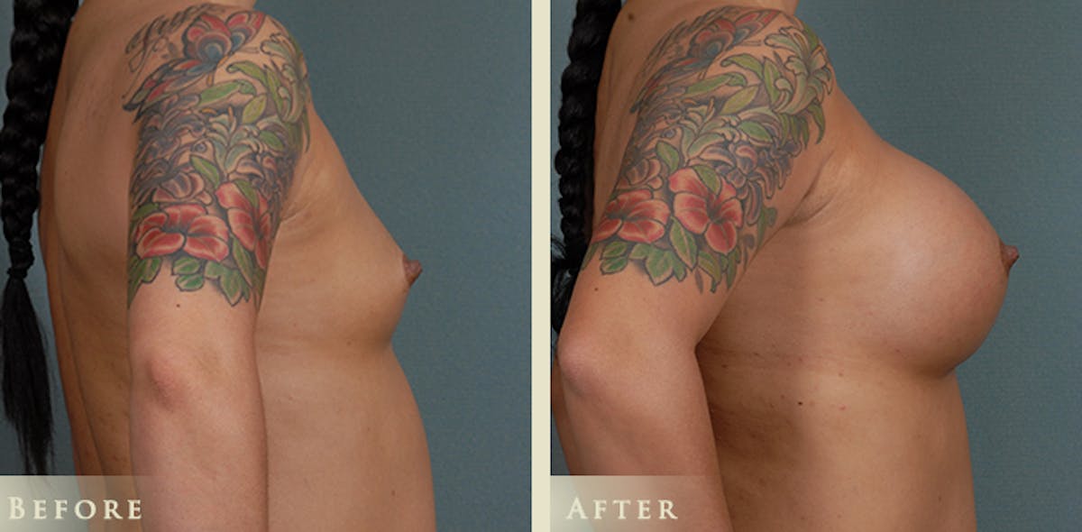 Breast Augmentation with Silicone Implants Before & After Gallery - Patient 244963 - Image 3