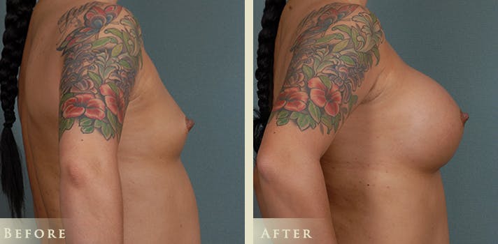Breast Augmentation Before & After Gallery - Patient 244963 - Image 3