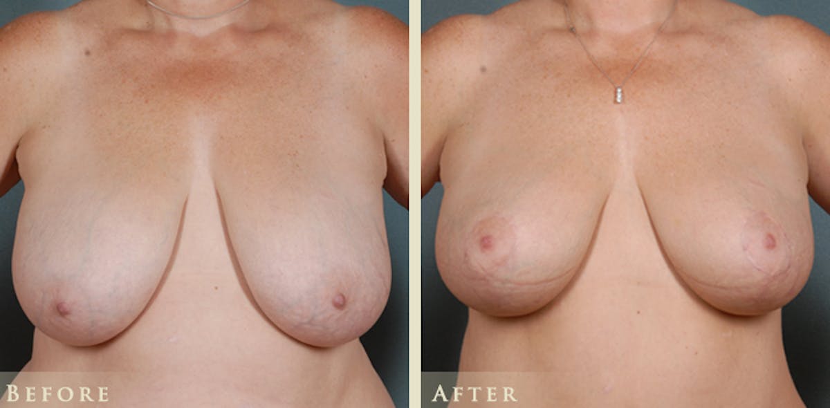 Breast Lift Before & After Gallery - Patient 370745 - Image 1
